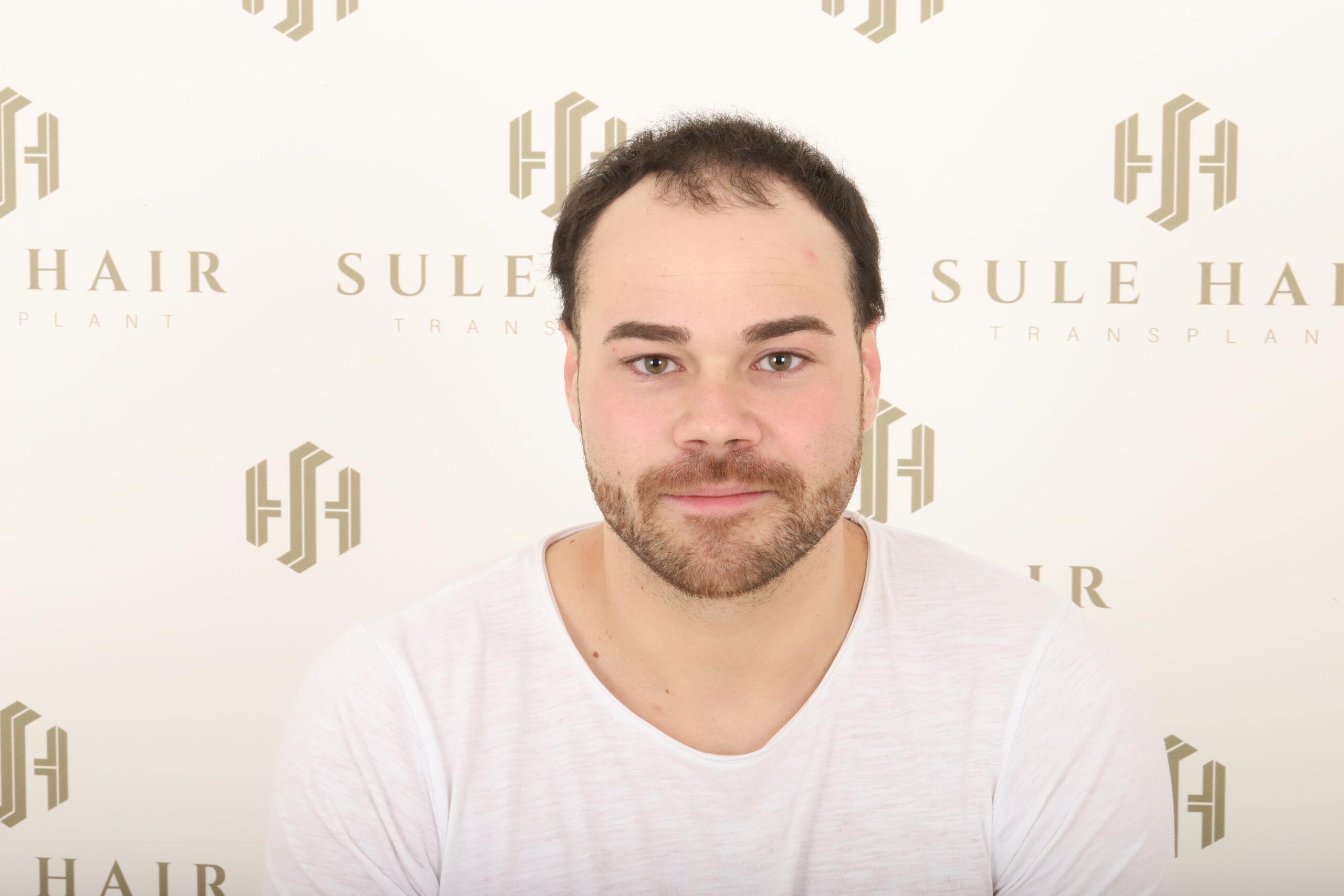 Haartransplantatie before