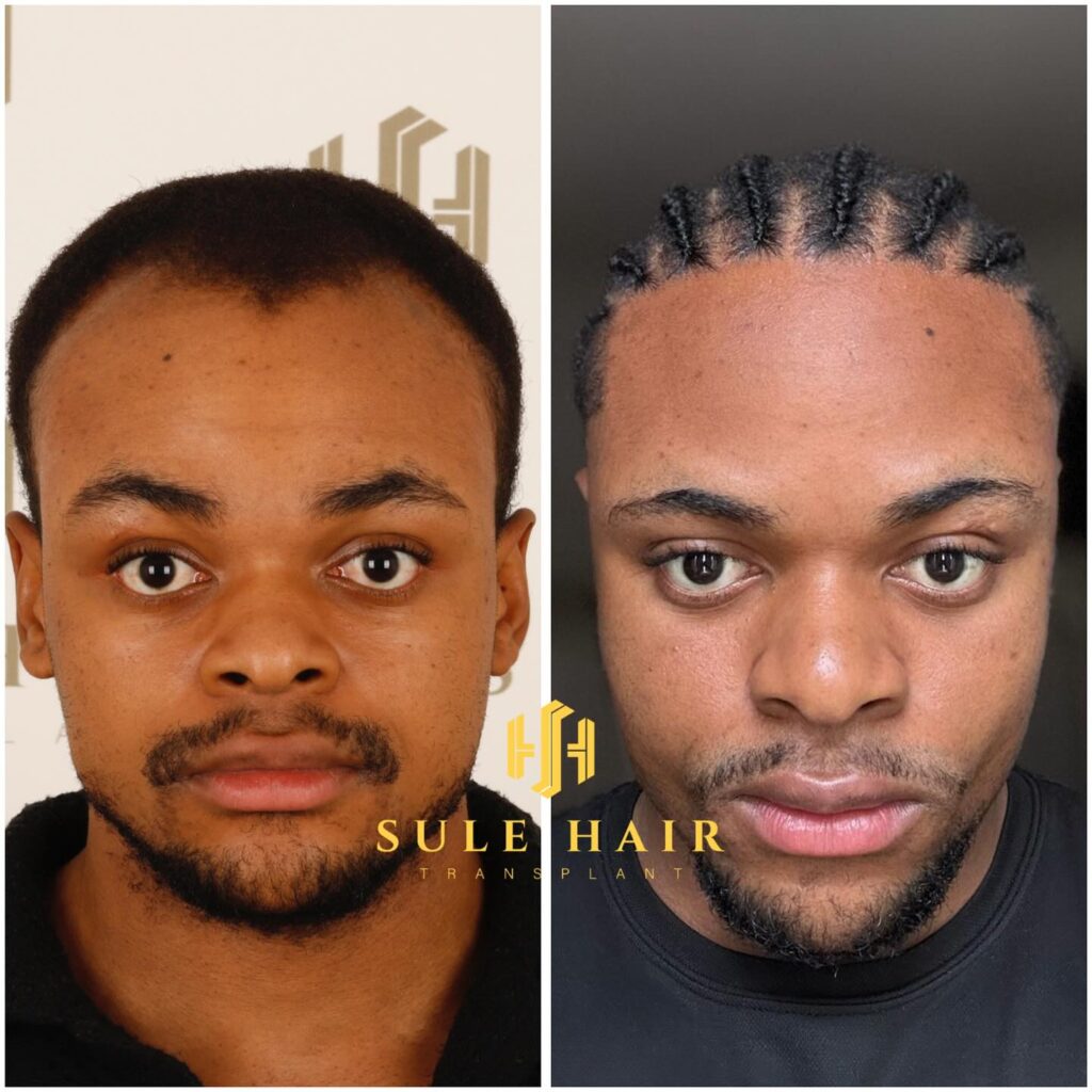 anonimostory.com_Instagram_sulehairtransplant_3616364050762677317_4608389442 (2)