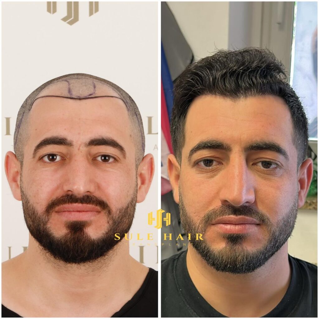 anonimostory.com_Instagram_sulehairtransplant_3731706163214700664_4608389442 (1)