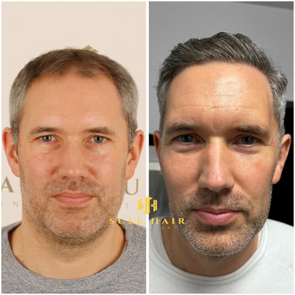 anonimostory.com_Instagram_sulehairtransplant_3772948246441013983_4608389442